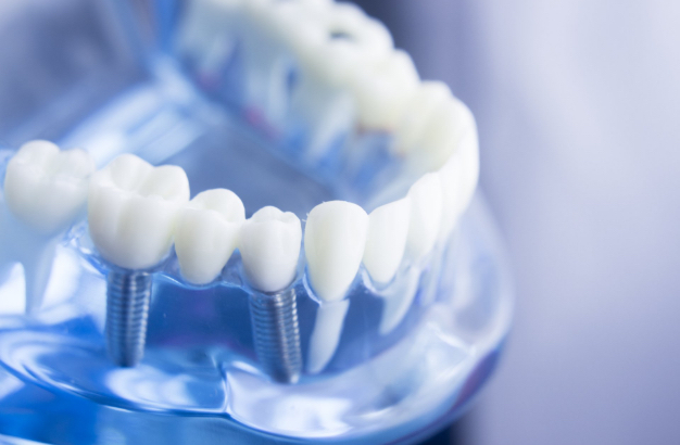 Dentista a Concorezzo: Implantologia, impianti su base azzurra