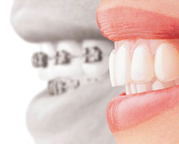 Ortodonzia a seregno | Studio Dentistico De Luca