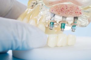 impianto dentale fisso - intervento